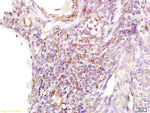 Formalin-fixed and paraffin embedded human cervical carcinoma tissue labeled with Anti GNPAT Polyclonal Antibody, Unconjugated (bs-5062R) at 1:100 followed by conjugation to the secondary antibody and DAB staining.