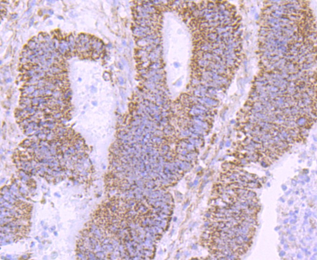 Paraformaldehyde-fixed and paraffin-embedded Human colon cancer tissue incubated with NUR77 (1C1) Monoclonal Antibody (bsm-52972R) at 1:100, overnight at 4°C, followed by a conjugated secondary antibody and DAB staining. Counterstained with hematoxylin.