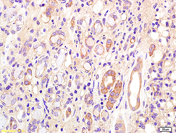 Formalin-fixed and paraffin embedded human kidney carcinoma labeled with Anti CD75 Polyclonal Antibody, Unconjugated (bs-3793R) at 1:200 followed by conjugation to the secondary antibody and DAB staining.