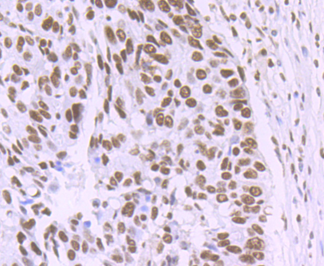 Paraformaldehyde-fixed and paraffin-embedded Human Lung Cancer tissue incubated with MATR3 (7C4) Monoclonal Antibody (bsm-54243R) at 1:100, overnight at 4\u00b0C, followed by a conjugated secondary antibody and DAB staining. Counterstained with hematoxylin.
