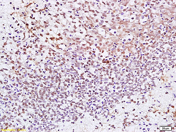 Formalin-fixed and paraffin embedded human gastric carcinoma labeled with Anti CENPF Polyclonal Antibody, Unconjugated (bs-7839R) at 1:200 followed by conjugation to the secondary antibody and DAB staining.