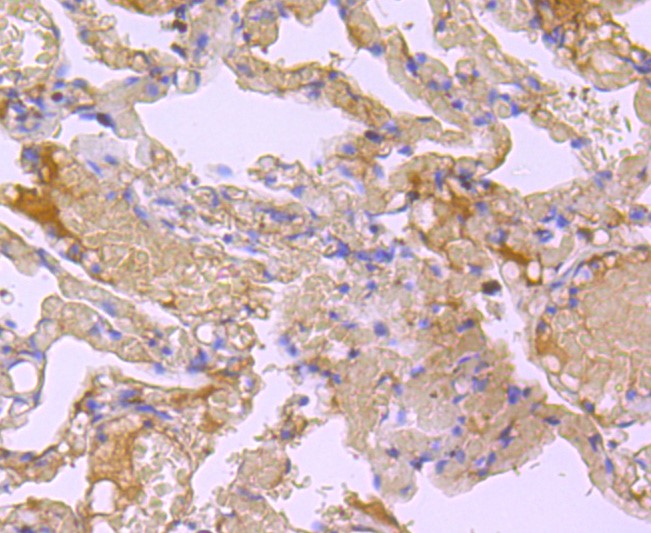 Paraformaldehyde-fixed and paraffin-embedded Human lung tissue incubated with Bid (9C9) Monoclonal Antibody (bsm-52967R) at 1:100, overnight at 4°C, followed by a conjugated secondary antibody and DAB staining. Counterstained with hematoxylin.