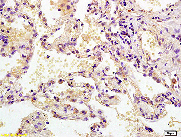 Formalin-fixed and paraffin embedded human lung carcinoma labeled with Anti MEK2\/MAPKK2 Polyclonal Antibody, Unconjugated (bs-0223R) at 1:200 followed by conjugation to the secondary antibody and DAB staining.