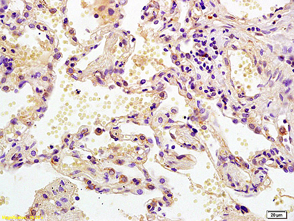 Formalin-fixed and paraffin embedded human lung carcinoma labeled with Anti MEK2/MAPKK2 Polyclonal Antibody, Unconjugated (bs-0223R) at 1:200 followed by conjugation to the secondary antibody and DAB staining.