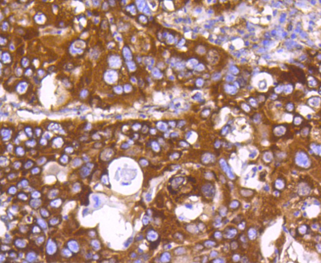 Paraformaldehyde-fixed and paraffin-embedded Human lung cancer tissue incubated with PHD1/prolyl hydroxylase (7G8) Monoclonal Antibody (bsm-52336R) at 1:100, overnight at 4°C, followed by a conjugated secondary antibody and DAB staining. Counterstained with hematoxylin.