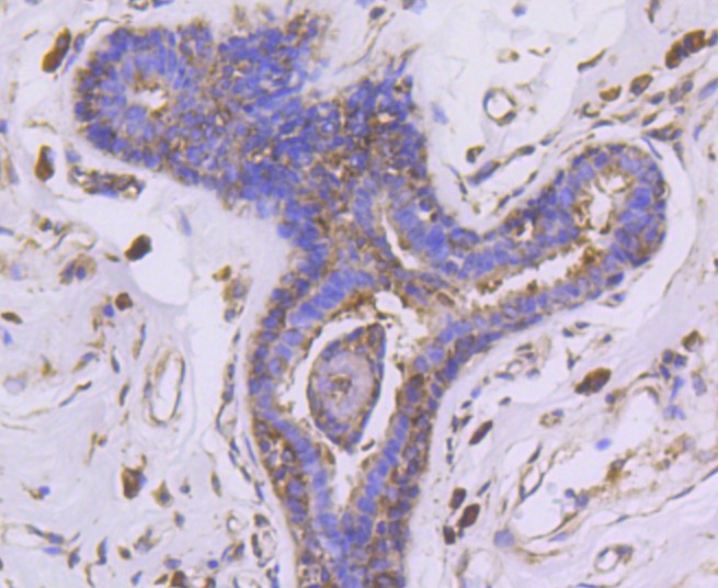 Paraformaldehyde-fixed and paraffin-embedded Human breast carcinoma tissue incubated with PHD1/prolyl hydroxylase (7G8) Monoclonal Antibody (bsm-52336R) at 1:100, overnight at 4°C, followed by a conjugated secondary antibody and DAB staining. Counterstained with hematoxylin.