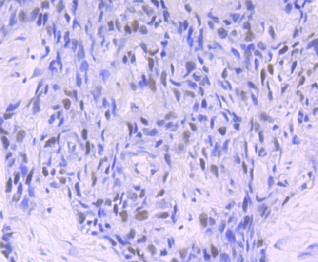 Paraformaldehyde-fixed and paraffin-embedded Human breast carcinoma tissue incubated with PMS2 (9H11) Monoclonal Antibody (bsm-52337R) at 1:100, overnight at 4°C, followed by a conjugated secondary antibody and DAB staining. Counterstained with hematoxylin.