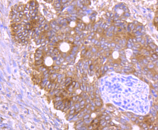 Paraformaldehyde-fixed and paraffin-embedded Human Colon Cancer tissue incubated with GORASP1 (3G1) Monoclonal Antibody (bsm-54260R) at 1:100, overnight at 4°C, followed by a conjugated secondary antibody and DAB staining. Counterstained with hematoxylin.