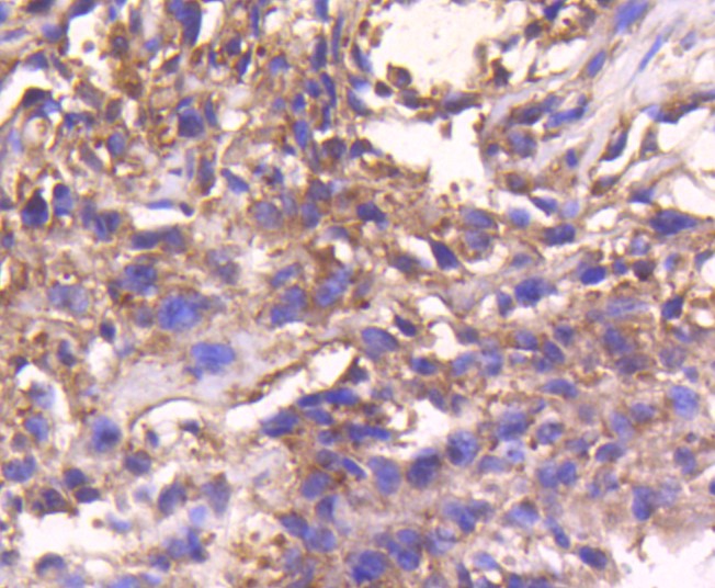 Paraformaldehyde-fixed and paraffin-embedded Human breast carcinoma tissue incubated with STAT3 (3F11) Monoclonal Antibody (bsm-52351R) at 1:100, overnight at 4°C, followed by a conjugated secondary antibody and DAB staining. Counterstained with hematoxylin.