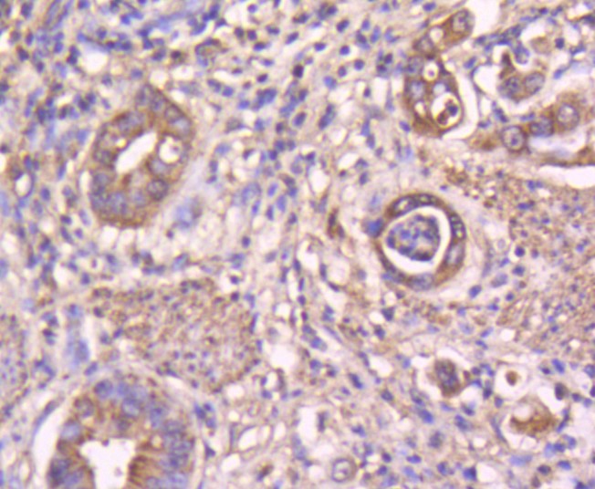 Paraformaldehyde-fixed and paraffin-embedded Human stomach carcinoma tissue incubated with STAT3 (3F11) Monoclonal Antibody (bsm-52351R) at 1:100, overnight at 4°C, followed by a conjugated secondary antibody and DAB staining. Counterstained with hematoxylin.