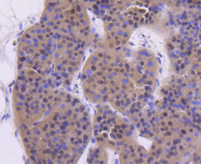 Paraformaldehyde-fixed and paraffin-embedded Human liver cancer tissue incubated with ATM (12A) Monoclonal Antibody (bsm-52360R) at 1:100, overnight at 4°C, followed by a conjugated secondary antibody and DAB staining. Counterstained with hematoxylin.