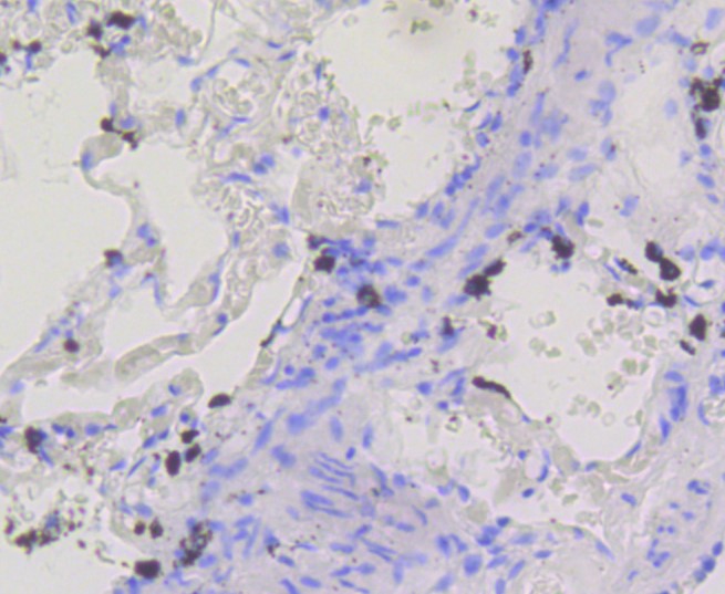 Paraformaldehyde-fixed and paraffin-embedded Human lung tissue incubated with BDNF (2A1) Monoclonal Antibody (bsm-52368R) at 1:100, overnight at 4\u00b0C, followed by a conjugated secondary antibody and DAB staining. Counterstained with hematoxylin.