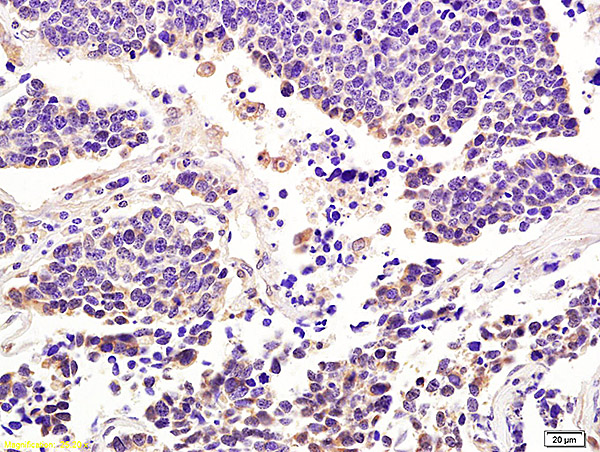 Formalin-fixed and paraffin embedded human lung carcinoma labeled with Anti-Integrin alpha 7/ITGA7 Polyclonal Antibody, Unconjugated (bs-1816R) at 1:200 followed by conjugation to the secondary antibody and DAB staining.