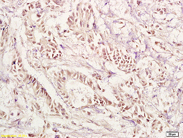 Formalin-fixed and paraffin embedded human gastric carcinoma labeled with Anti-PAX1 Polyclonal Antibody, Unconjugated (bs-1199R) at 1:200 followed by conjugation to the secondary antibody and DAB staining.