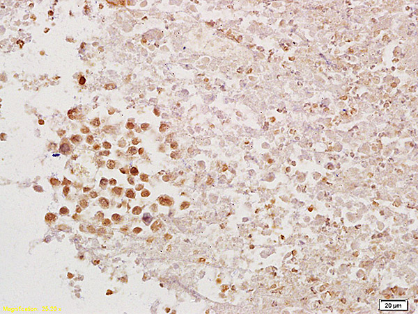 Formalin-fixed and paraffin embedded mouse tumor tissue labeled with Anti-PAX1 Polyclonal Antibody, Unconjugated (bs-1199R) at 1:200 followed by conjugation to the secondary antibody and DAB staining.