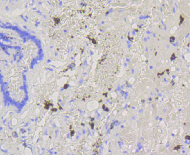 Paraformaldehyde-fixed and paraffin-embedded Human lung tissue incubated with ABCG1 (8H2) Monoclonal Antibody (bsm-52414R) at 1:100, overnight at 4°C, followed by a conjugated secondary antibody and DAB staining. Counterstained with hematoxylin.