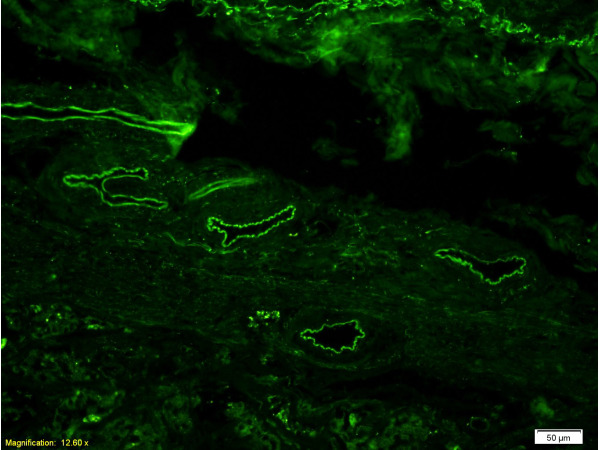 Formalin-fixed and paraffin embedded human gastric adenocarcinoma labeled Anti-CD34 Polyclonal Antibody, Unconjugated (bs-0646R) at 1:200, followed by conjugation to the secondary antibody Goat Anti-Rabbit IgG, AF488 conjugated(bs-0295G-AF488)used at 1:200 dilution for 40 minutes at 37°C