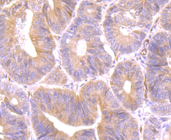 Paraformaldehyde-fixed and paraffin-embedded Human Colon Cancer tissue incubated with Securin (1F10) Monoclonal Antibody (bsm-54295R) at 1:100, overnight at 4°C, followed by a conjugated secondary antibody and DAB staining. Counterstained with hematoxylin.