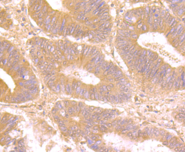 Paraformaldehyde-fixed and paraffin-embedded Human Colon Cancer tissue incubated with Galectin 8 (1A4) Monoclonal Antibody (bsm-54301R) at 1:100, overnight at 4°C, followed by a conjugated secondary antibody and DAB staining. Counterstained with hematoxylin.