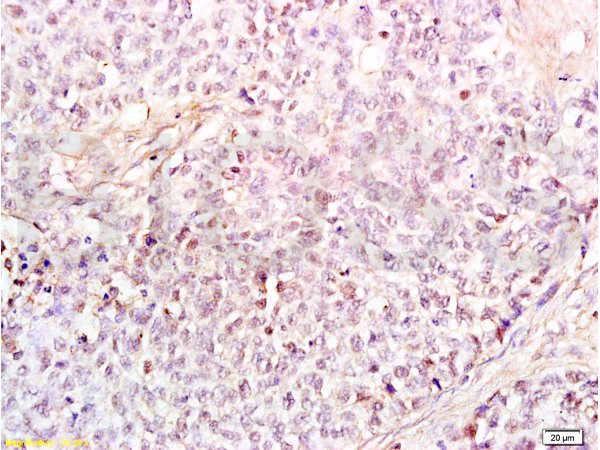 Formalin-fixed and paraffin embedded human endometrium carcinoma labeled Anti-HMGB1 Polyclonal Antibody, Unconjugated (bs-0664R) at 1:200, followed by conjugation to the secondary antibody and DAB staining