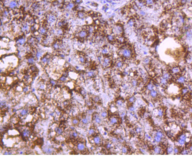 Paraformaldehyde-fixed and paraffin-embedded Human liver tissue incubated with Cathepsin D (2G4) Monoclonal Antibody (bsm-52429R) at 1:300, overnight at 4°C, followed by a conjugated secondary antibody and DAB staining. Counterstained with hematoxylin.