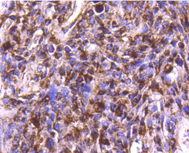 Paraformaldehyde-fixed and paraffin-embedded Human breast carcinoma tissue incubated with Cathepsin D (2G4) Monoclonal Antibody (bsm-52429R) at 1:300, overnight at 4°C, followed by a conjugated secondary antibody and DAB staining. Counterstained with hematoxylin.