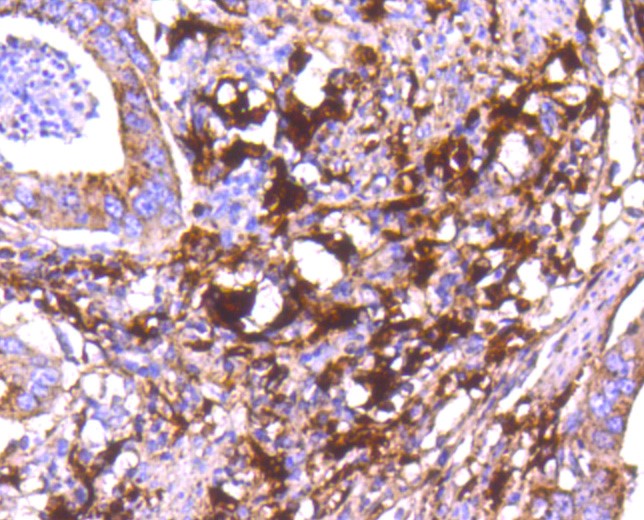 Paraformaldehyde-fixed and paraffin-embedded Human stomach carcinoma tissue incubated with Cathepsin D (2G4) Monoclonal Antibody (bsm-52429R) at 1:300, overnight at 4°C, followed by a conjugated secondary antibody and DAB staining. Counterstained with hematoxylin.