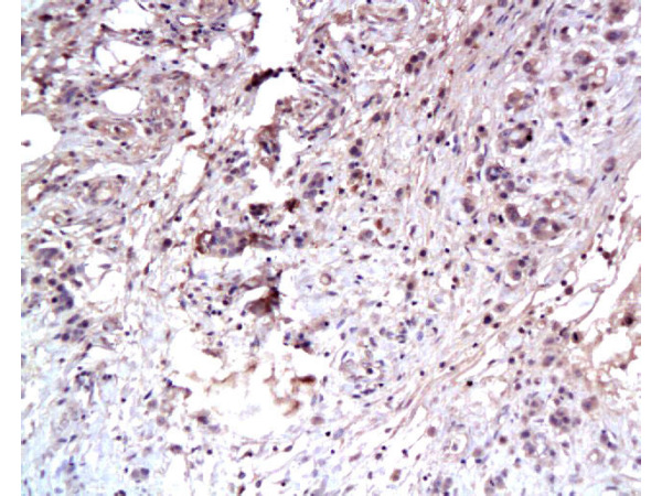 Formalin-fixed and paraffin embedded human gastric carcinoma labeled Anti-C-Met Polyclonal Antibody, Unconjugated (bs-0668R) at 1:100, followed by conjugation to the secondary antibody and DAB staining