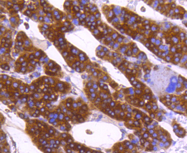 Paraformaldehyde-fixed and paraffin-embedded Human liver cancer tissue incubated with Calreticulin (3D1) Monoclonal Antibody (bsm-52436R) at 1:100, overnight at 4°C, followed by a conjugated secondary antibody and DAB staining. Counterstained with hematoxylin.