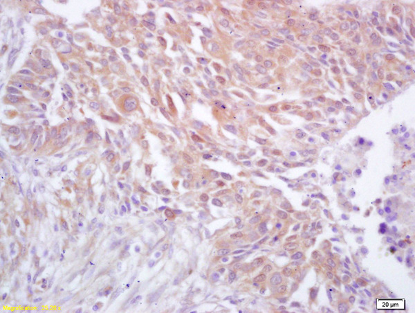 Formalin-fixed and paraffin embedded human lung carcinoma labeled with Rabbit Anti CDC37 Polyclonal Antibody, Unconjugated (bs-4290R) at 1:200 followed by conjugation to the secondary antibody and DAB staining