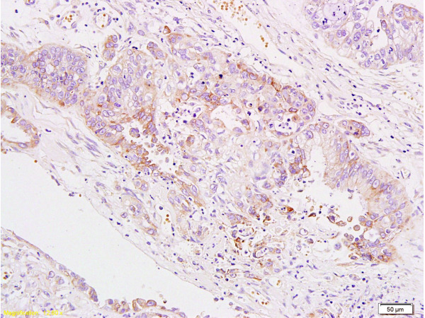 Formalin-fixed and paraffin embedded human gastric carcinoma labeled Anti-B7H4 Polyclonal Antibody, Unconjugated (bs-0673R) at 1:200, followed by conjugation to the secondary antibody and DAB staining