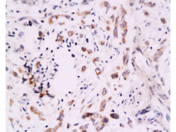 Formalin-fixed and paraffin embedded human colon carcinoma labeled Anti-B7H4 Polyclonal Antibody, Unconjugated (bs-0673R) at 1:200, followed by conjugation to the secondary antibody and DAB staining