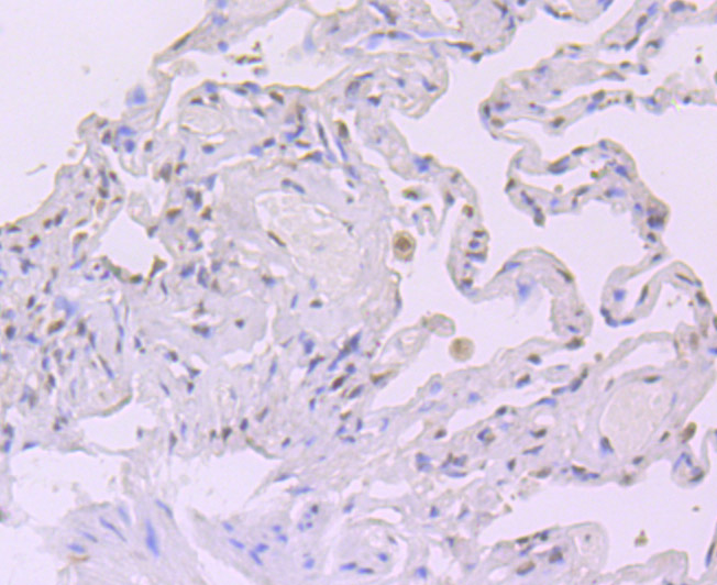 Paraformaldehyde-fixed and paraffin-embedded Human Lung Cancer tissue incubated with Exportin-1 (2C4) Monoclonal Antibody (bsm-54273R) at 1:100, overnight at 4°C, followed by a conjugated secondary antibody and DAB staining. Counterstained with hematoxylin.