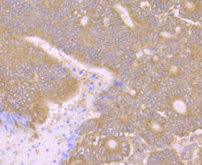 Paraformaldehyde-fixed and paraffin-embedded Human Colon Cancer tissue incubated with PCK2 (12C5) Monoclonal Antibody (bsm-54275R) at 1:100, overnight at 4°C, followed by a conjugated secondary antibody and DAB staining. Counterstained with hematoxylin.
