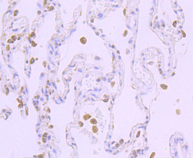 Paraformaldehyde-fixed and paraffin-embedded Human Lung Cancer tissue incubated with Cytochrome P450 Oxidoreductase (4F7) Monoclonal Antibody (bsm-54281R) at 1:100, overnight at 4°C, followed by a conjugated secondary antibody and DAB staining. Counterstained with hematoxylin.