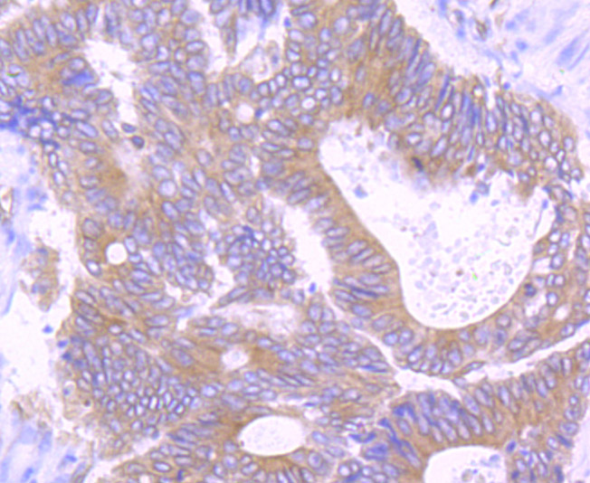 Paraformaldehyde-fixed and paraffin-embedded Human Colon Cancer tissue incubated with TGF alpha (1H8) Monoclonal Antibody (bsm-54286R) at 1:100, overnight at 4°C, followed by a conjugated secondary antibody and DAB staining. Counterstained with hematoxylin.