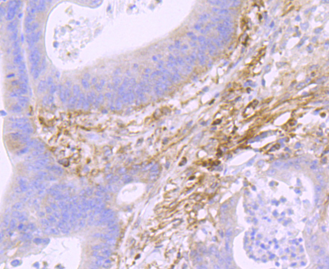 Paraformaldehyde-fixed and paraffin-embedded Human Colon Cancer tissue incubated with Podoplanin (3C3) Monoclonal Antibody (bsm-52936R) at 1:100, overnight at 4°C, followed by a conjugated secondary antibody and DAB staining. Counterstained with hematoxylin.