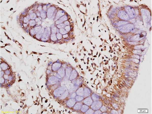Formalin-fixed and paraffin embedded human colon tissue labeled Anti-IL-10 Polyclonal Antibody, Unconjugated(bs-0698R) at 1:200, followed by conjugation to the secondary antibody and DAB staining
