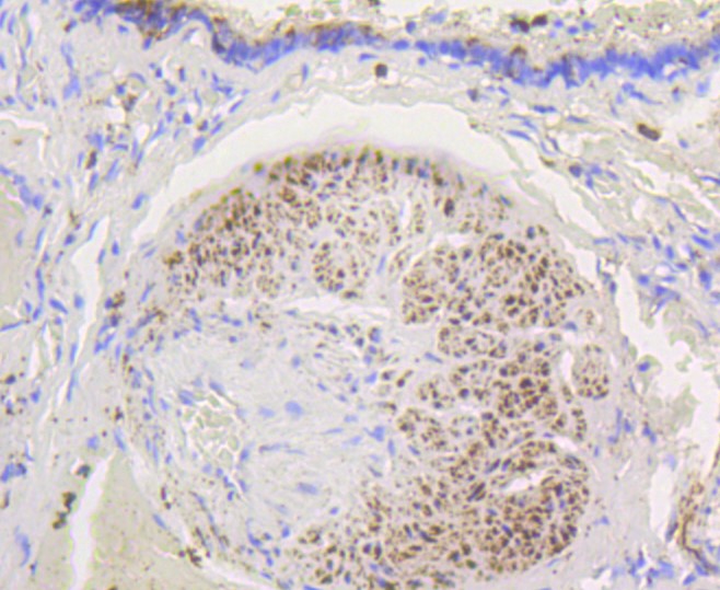 Paraformaldehyde-fixed and paraffin-embedded Human lung tissue incubated with Hexokinase 1 (7B9) Monoclonal Antibody (bsm-52452R) at 1:100, overnight at 4°C, followed by a conjugated secondary antibody and DAB staining. Counterstained with hematoxylin.