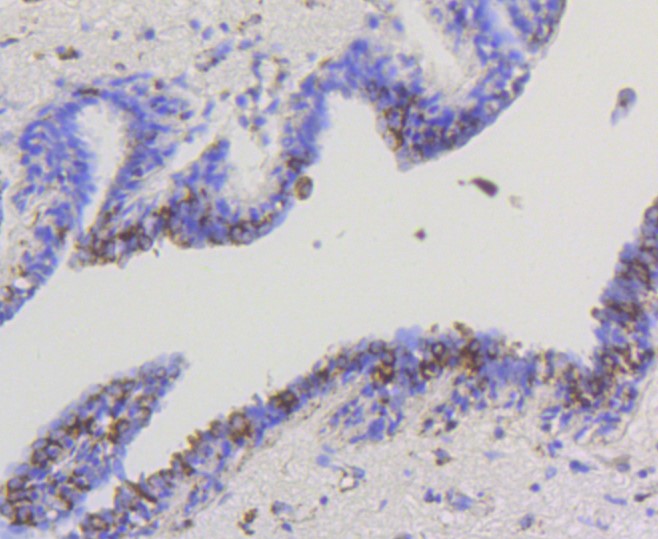 Paraformaldehyde-fixed and paraffin-embedded Human breast carcinoma tissue incubated with Hexokinase 1 (7B9) Monoclonal Antibody (bsm-52452R) at 1:100, overnight at 4°C, followed by a conjugated secondary antibody and DAB staining. Counterstained with hematoxylin.