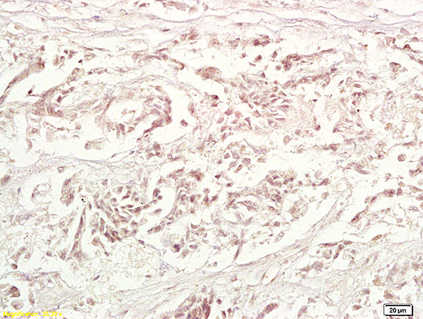 Formalin-fixed and paraffin embedded human gastric carcinoma labeled with Anti-TRAF1 Polyclonal Antibody, Unconjugated (bs-1212R) at 1:200 followed by conjugation to the secondary antibody and DAB staining. Formalin-fixed and paraffin embedded human gastric carcinoma labeled with Anti-TRAF1 Polyclonal Antibody, Unconjugated (bs-1212R) at 1:200 followed by conjugation to the secondary antibody and DAB staining.
