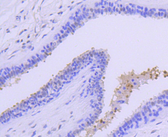 Paraformaldehyde-fixed and paraffin-embedded Human breast carcinoma tissue incubated with PRMT5 (28A3) Monoclonal Antibody (bsm-52463R) at 1:100, overnight at 4°C, followed by a conjugated secondary antibody and DAB staining. Counterstained with hematoxylin.