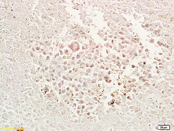 Formalin-fixed and paraffin embedded mouse tumor tissue labeled with Anti-TRAF1 Polyclonal Antibody, Unconjugated (bs-1212R) at 1:200 followed by conjugation to the secondary antibody and DAB staining. Formalin-fixed and paraffin embedded mouse tumor tissue labeled with Anti-TRAF1 Polyclonal Antibody, Unconjugated (bs-1212R) at 1:200 followed by conjugation to the secondary antibody and DAB staining.