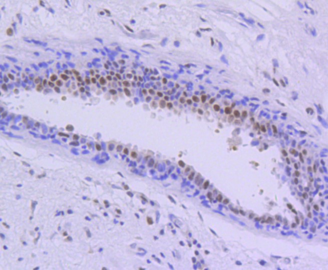 Paraformaldehyde-fixed and paraffin-embedded Human breast carcinoma tissue incubated with PIM1 (5A12) Monoclonal Antibody (bsm-52472R) at 1:100, overnight at 4°C, followed by a conjugated secondary antibody and DAB staining. Counterstained with hematoxylin.