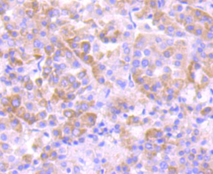 Paraformaldehyde-fixed and paraffin-embedded Human Liver Cancer tissue incubated eEF1A1 (3F9) Monoclonal Antibody (bsm-54320R) at 1:100, overnight at 4°C, followed by a conjugated secondary antibody and DAB staining. Counterstained with hematoxylin.