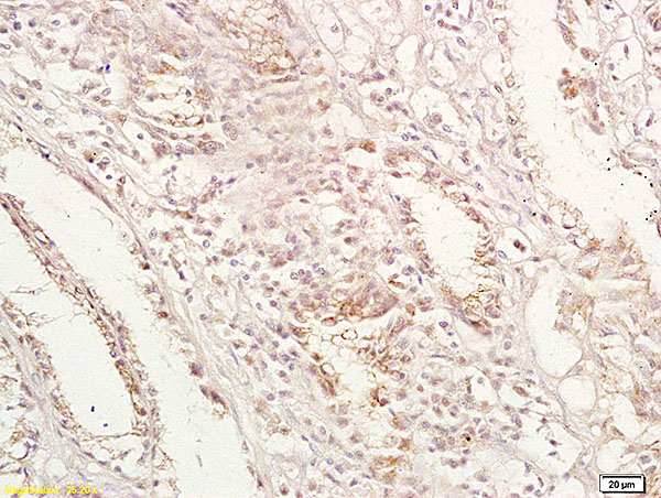 Formalin-fixed and paraffin embedded human gastric carcinoma labeled with Anti-GPA33 Polyclonal Antibody, Unconjugated (bs-1226R) at 1:200 followed by conjugation to the secondary antibody and DAB staining.