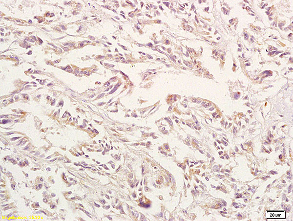 Formalin-fixed and paraffin embedded human gastric carcinoma labeled with Anti-GPA33 Polyclonal Antibody, Unconjugated (bs-1226R) at 1:200 followed by conjugation to the secondary antibody and DAB staining.