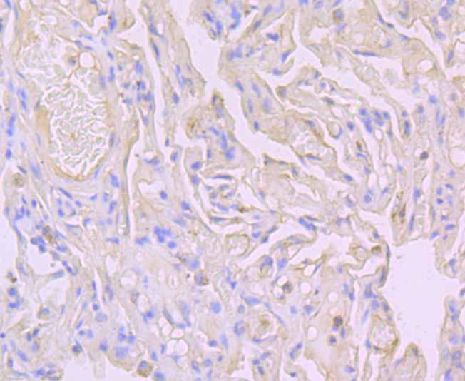 Paraformaldehyde-fixed and paraffin-embedded Human Lung Cancer tissue incubated with Flotillin 1 (4C3) Monoclonal Antibody (bsm-54325R) at 1:100, overnight at 4°C, followed by a conjugated secondary antibody and DAB staining. Counterstained with hematoxylin.