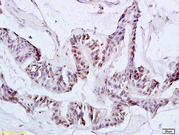 Formalin-fixed and paraffin embedded human colon carcinoma labeled with Anti-Ack1 Polyclonal Antibody, Unconjugated (bs-1227R) at 1:200 followed by conjugation to the secondary antibody and DAB staining.