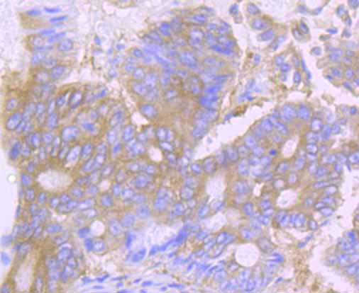 Paraformaldehyde-fixed and paraffin-embedded Human Colon Cancer tissue incubated with Desmoglein-1 (5C11) Monoclonal Antibody (bsm-54326R) at 1:100, overnight at 4°C, followed by a conjugated secondary antibody and DAB staining. Counterstained with hematoxylin.